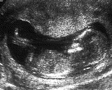 NHS and private ultrasound scans during pregnancy